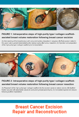 Breast Cancer Excision Repair and Reconstruction